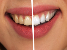 Cada vez hay más productos que aseguran que podemos ganar tonos de blancura en nuestros dientes
