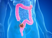 Recreación de un cáncer colorrectal