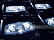 Radiografía que muestra cáncer de próstata