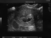 Ecografía de un embarazo de 7 semanas