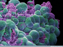 Células cancerígenas de cáncer de mama