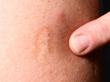 A scar from a smallpox vaccination is visible on an upper arm.