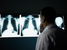 Un médico examina una radiografía de tórax