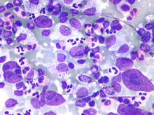 Linfoma de Hodgkin