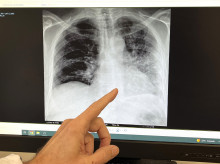 Radiografía de un paciente fumador en la que se señala la base del pulmón izquierdo, afectado de cáncer de pulmón