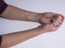 Los cortes y las quemaduras pueden surgir por una mala regulación de las emociones