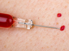 Angiomas rubí