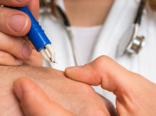 Un médico sacando una garrapata