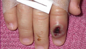 Las pústulas son características de quién se ha contagiado de viruela