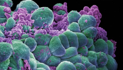 Células cancerígenas de cáncer de mama