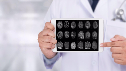 El Alzheimer se debe a la disminución de las proteínas y no por acumular placas amiloides, según un nuevo estudio