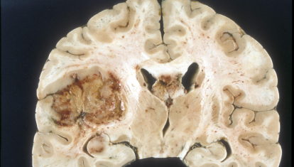 Cerebro con un glioblastoma