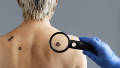Cáncer de piel