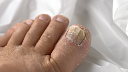 Uñas de los pies agrietadas