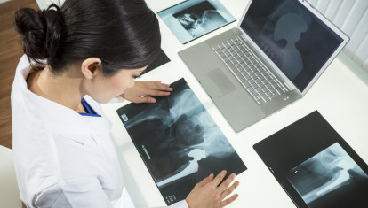 La artroplastia total de cadera es un tratamiento común para la osteoartritis de cadera