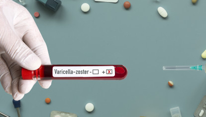 El virus varicela-zóster puede causar enfermedades graves más allá de la varicela y el herpes zóster