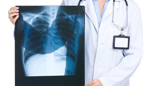 Cáncer de pulmón