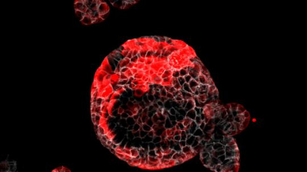 Organoide de cáncer colorrectal con las células residuales responsables de la recaída en rojo.