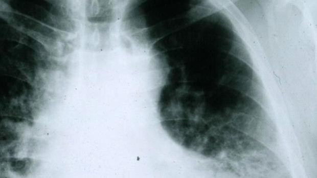 Cáncer pulmón