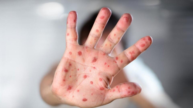 La viruela del mono es la nueva preocupación sanitaria a nivel mundial