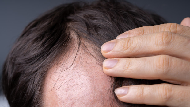Close-up Of Young Man Checking Hairline At Home.Man,Checking,Hairline,At,Home,man, checking, balding, hair, home, loss, hairline, scalp,man, checking, balding, hair, home, loss, hairline, scalp,man, checking, balding, hair, home, loss, hairline, scalp, dandruff, lose, lice, head, receding, skin, hairloss, having, pain, sick, view, scrutiny, age, headache, body, losing, problem, men, front, care, painful, concern, feeling, examining, baldness, male, skincare, touching, adult, closeup, wellbeing, mid, indoors, caucasian