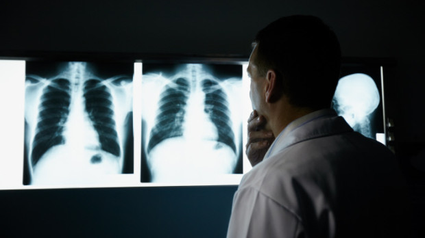 Un médico examina una radiografía de tórax