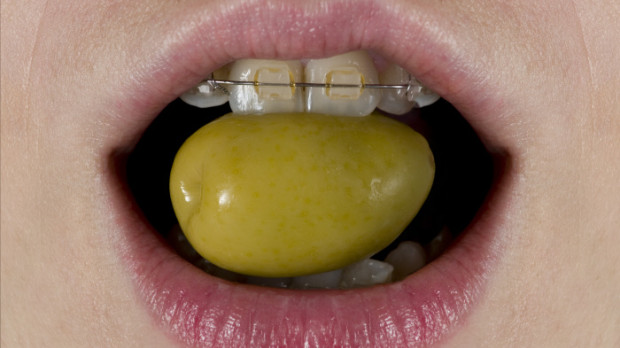 Brackets