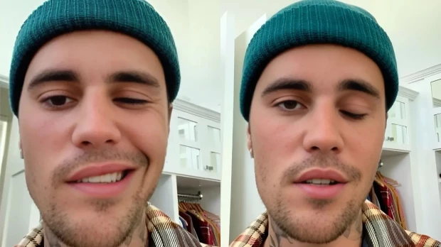 La cara paralizada de Justin Bieber