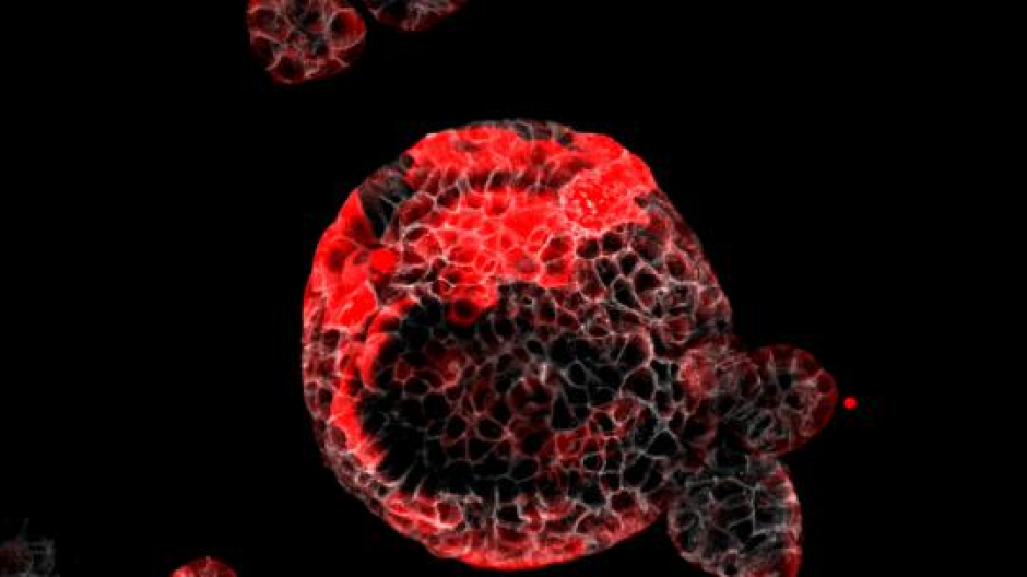 Organoide de cáncer colorrectal con las células residuales responsables de la recaída en rojo.