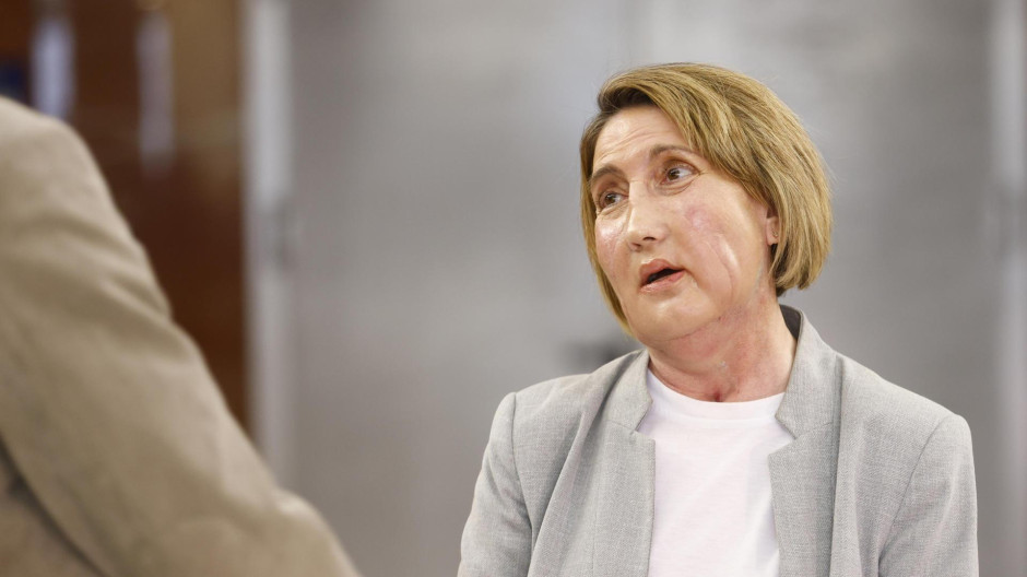 Carmen, la primera paciente en recibir un trasplante de cara de una donante que recibió una eutanasia