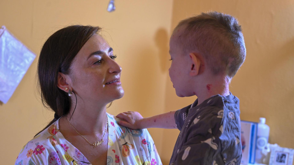 Zulema Hernández convierte cada semana las dolorosas curas de Karim, un niño de tres años con piel de mariposa