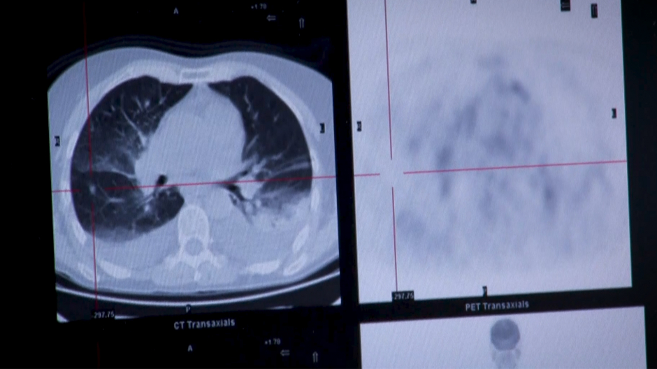 Imagen de una radiografía de pulmón