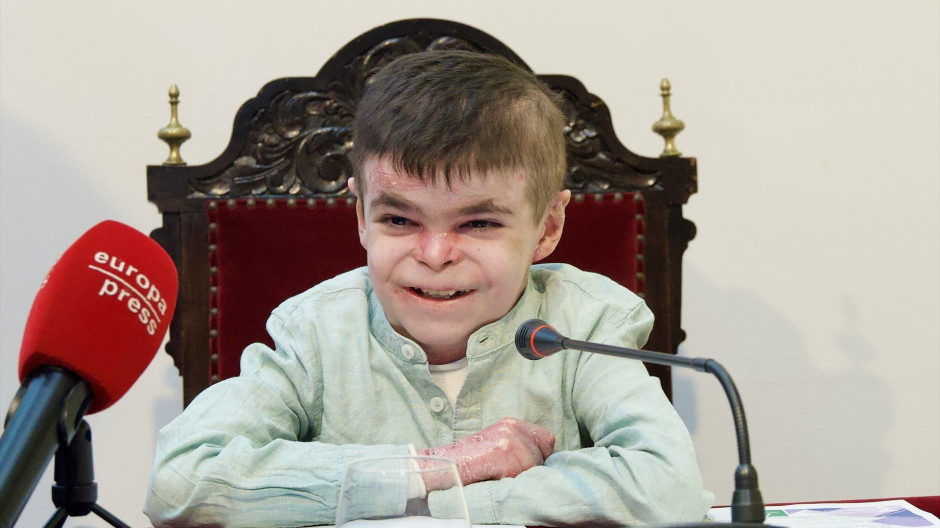 El pequeño Leo, con la enfermedad pie de mariposa
