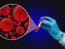 salud-y-bienestar/salud/20260905/mieloma-multiple-sencilla-prueba-permite-anticipar-riesgo-este-cancer-sangre_454209