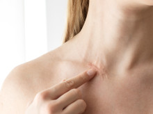 salud-y-bienestar/salud/20260519/cicatrices-tambien-duelen-problema-salud-alla-estetica_418637