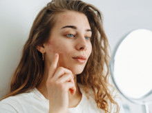 salud-y-bienestar/bienestar/20260720/esta-aumentando-acne-adultos_439523