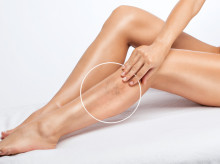 salud-y-bienestar/salud/20260827/asi-tratan-varices-anestesia-menos-hora_444456