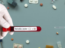 salud-y-bienestar/salud/20260906/virus-varicelazoster-graves-enfermedades-puede-causar-ademas-varicela-herpes_455239