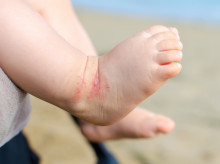 salud-y-bienestar/bienestar/20260914/dermatitis-atopica-como-cuidar-piel-antes-aparezcan-brotes_457789