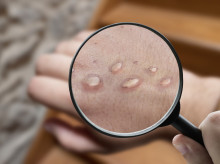 salud-y-bienestar/salud/20260918/caso-viruela-mono-ceuta-como-contagia-este-virus_460133