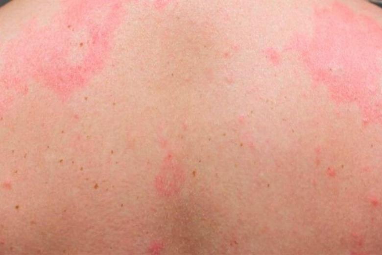 Sarpullidos. Se conocen varios casos de sarpullidos por la piel causados tras el contagio por covid. Suelen ser muy molestos y la irritación puede durar varias semanas.