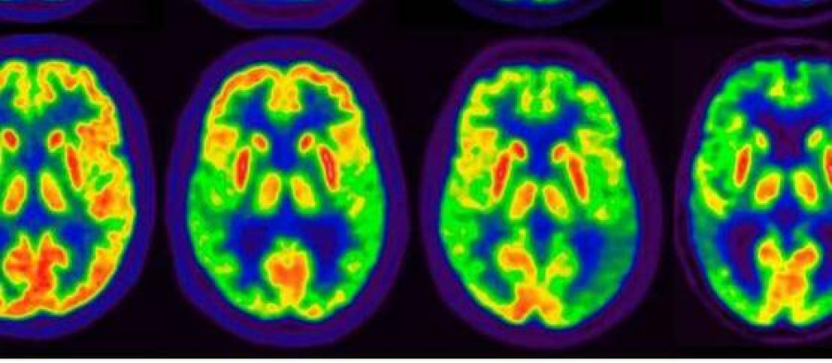 Imagen de un PET que muestra la progresión del alzhéimer