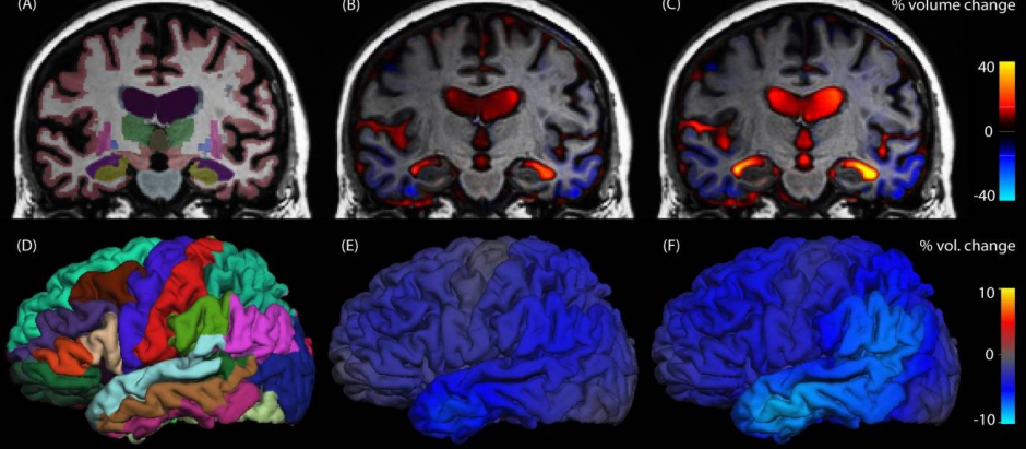 Estos escaneos cerebrales de MRI, tomados con seis meses de diferencia, muestran la progresión de un deterioro cognitivo leve a la enfermedad de Alzheimer