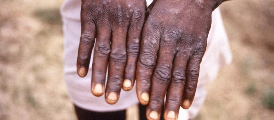 Las autoridades británicas están encontrando casos sin contactos con personas de África occidental