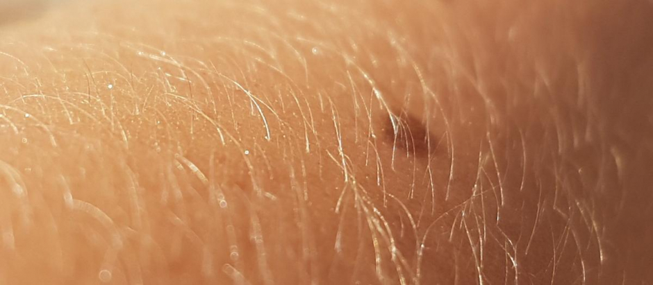 Al incluir a pacientes con diferentes colores de piel, los investigadores han ampliado el espectro de resolución a diversas formas de melanoma