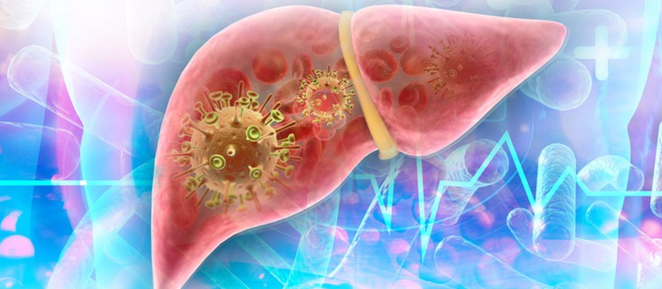 Ilustración de cómo afecta una hepatitis sobre el hígado