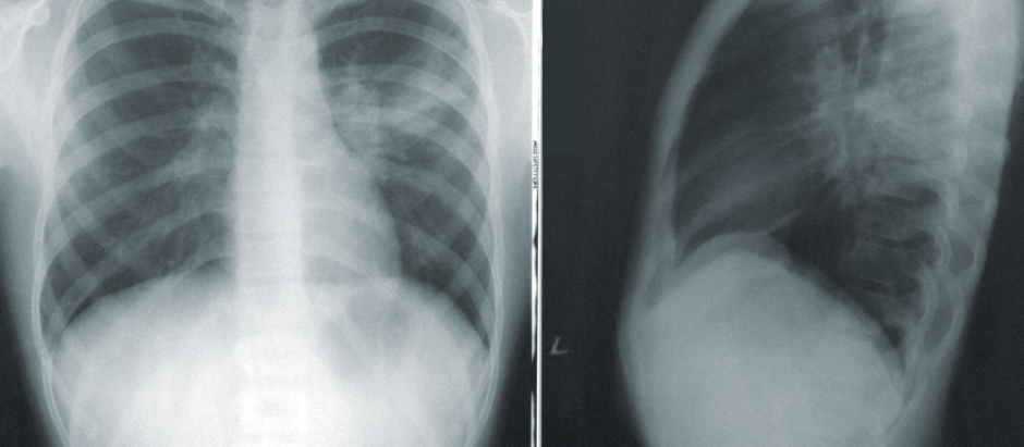 Radiografía de pulmón de una persona con coronavirus