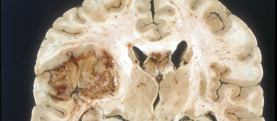 Cerebro con un glioblastoma