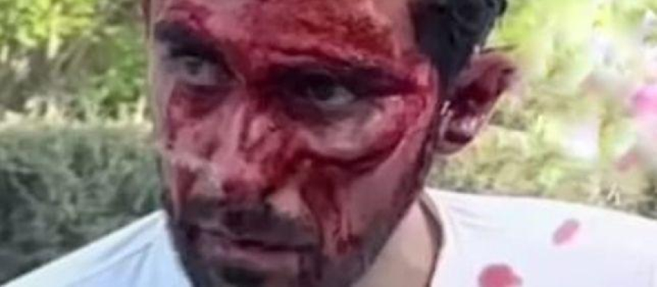 Alberto Contador, con la cara llena de sangre tras su caída
