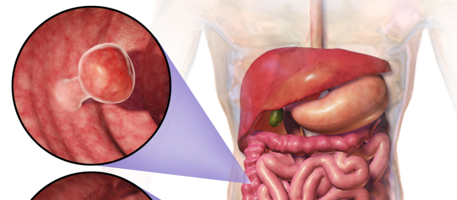El cancer de colon se origina por pólipos que terminan derivando en tumor